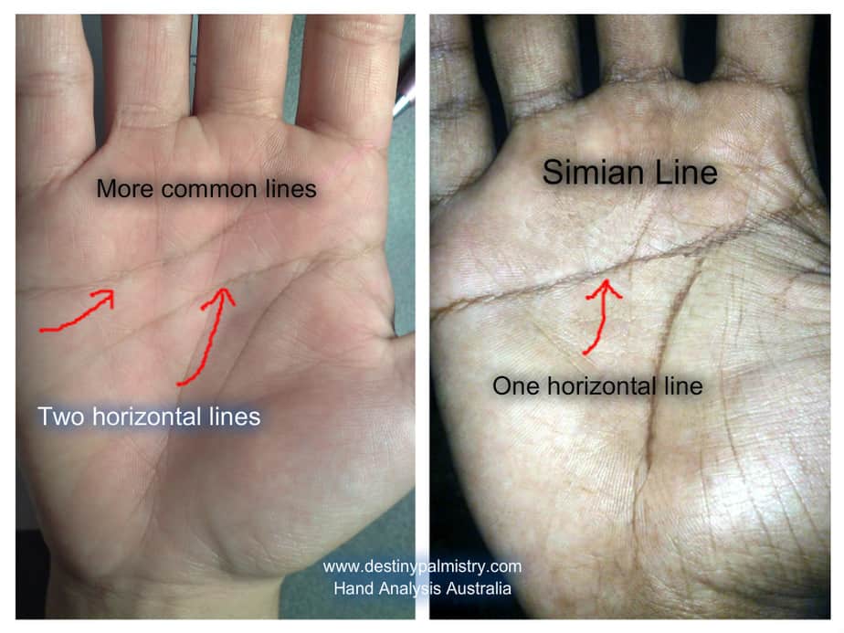 Simian Crease the Single Horizontal Palm Line.