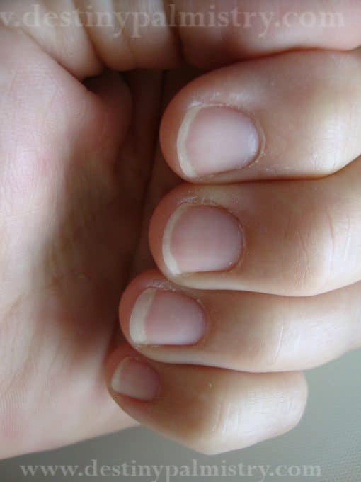 white fingernails, fingernail ridges, health warnings from the fingernails, white coloured nails, palm reading