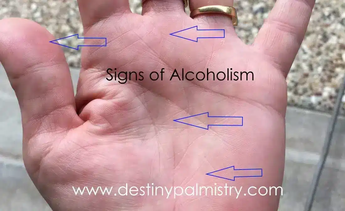 Signs of Alcoholism in Palmistry?