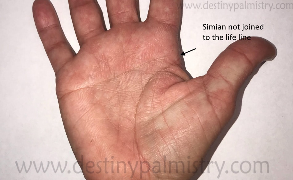 Palmar bilateral creases single Microphthalmia and