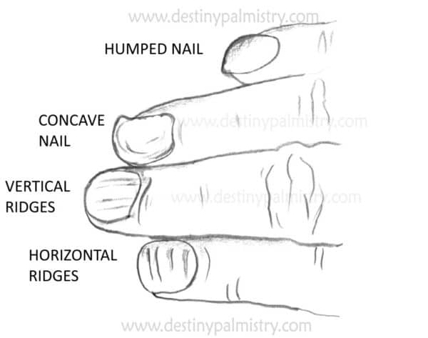 humped nail, concave fingernail, ridges on fingernails